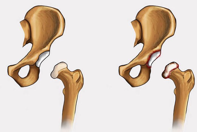 zmiany zwyrodnieniowe i bóle stawu biodrowego