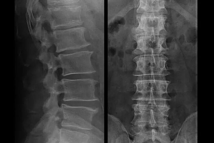 osteochondroza na zdjęciu rentgenowskim