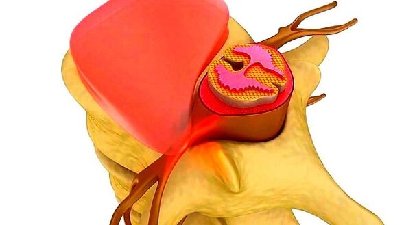 Osteochondroza kręgosłupa klatki piersiowej Esencja choroby