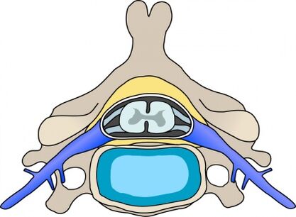 Protabius w kręgu z osteochondrozą szyjki macicy